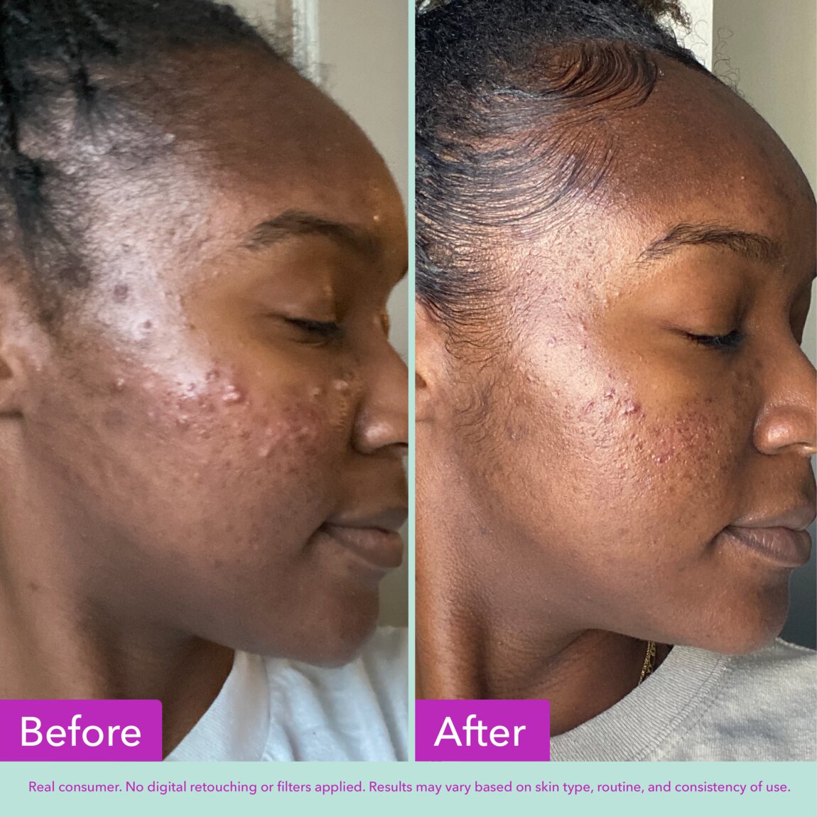 acne-foaming-cleanser-x6 zb_p.jpg